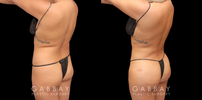 Full 360 view of patient following liposuction surgery focusing on removing belly fat, fat around the waist, and tailbone fat for a contoured result from every angle.