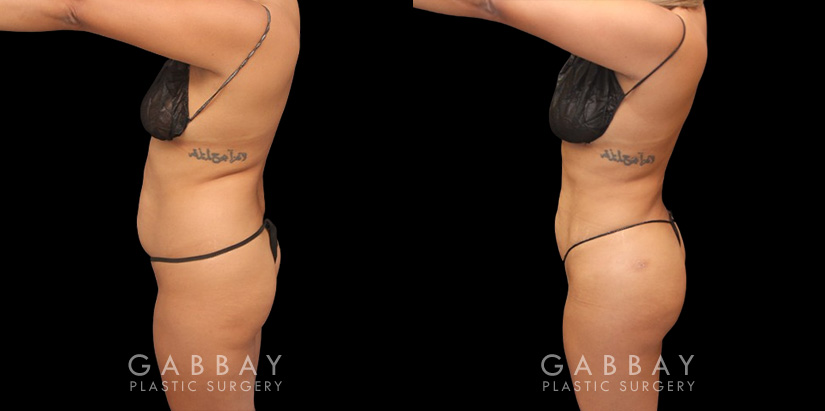 Full 360 view of patient following liposuction surgery focusing on removing belly fat, fat around the waist, and tailbone fat for a contoured result from every angle.