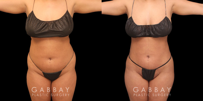 Female patient after stomach fat removal surgery. Results after complete healing show a flattened stomach and reduction in “rolls” of fat beneath the arms and around the mid-torso.