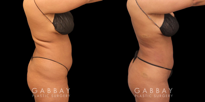 Female patient after stomach fat removal surgery. Results after complete healing show a flattened stomach and reduction in “rolls” of fat beneath the arms and around the mid-torso.
