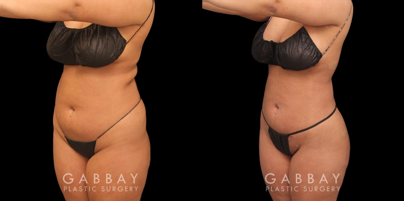 Female patient after stomach fat removal surgery. Results after complete healing show a flattened stomach and reduction in “rolls” of fat beneath the arms and around the mid-torso.