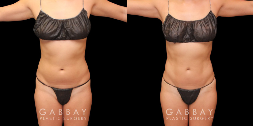 Abdomen Lipo Before and After Photo Gallery, Page 6 of 6