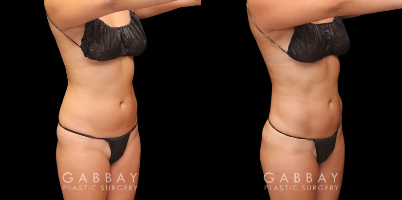 Female patient in her 30s wanted to reduce mild stomach fat bulging from stubborn pockets of fat. Liposuction removed the fat and restored a smoother belly contour visible from multiple sides.