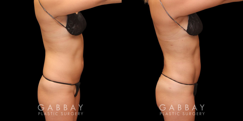 Female patient in her 30s wanted to reduce mild stomach fat bulging from stubborn pockets of fat. Liposuction removed the fat and restored a smoother belly contour visible from multiple sides.