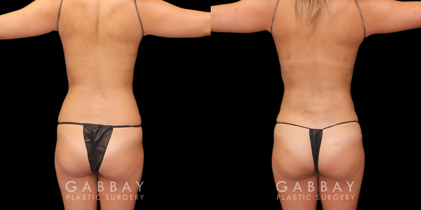 Female patient in her 30s wanted to reduce mild stomach fat bulging from stubborn pockets of fat. Liposuction removed the fat and restored a smoother belly contour visible from multiple sides.
