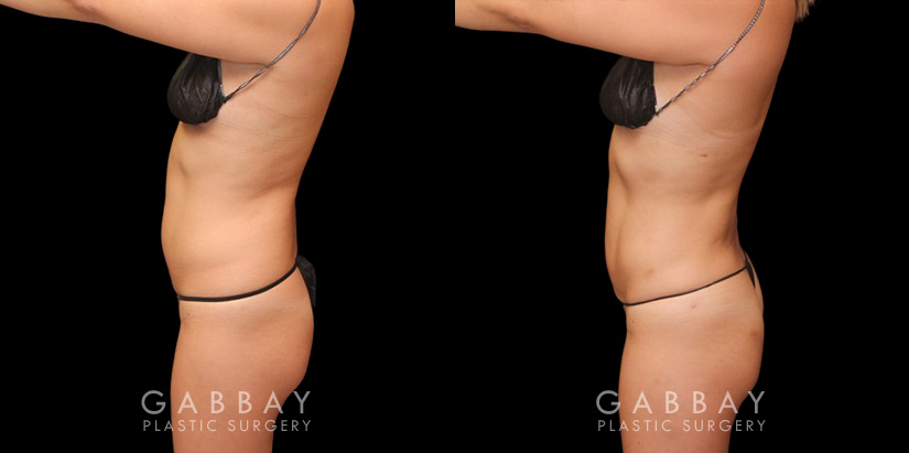 Female patient in her 30s wanted to reduce mild stomach fat bulging from stubborn pockets of fat. Liposuction removed the fat and restored a smoother belly contour visible from multiple sides.