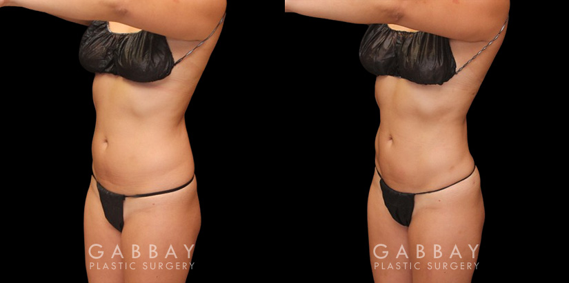 Female patient in her 30s wanted to reduce mild stomach fat bulging from stubborn pockets of fat. Liposuction removed the fat and restored a smoother belly contour visible from multiple sides.