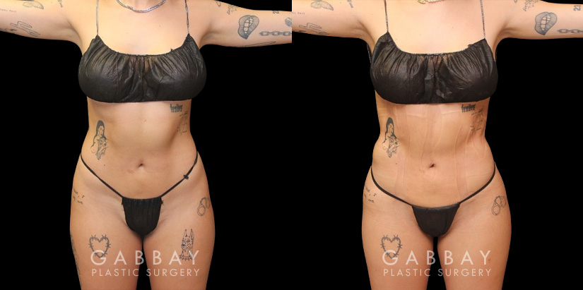 Female patient after precise liposuction techniques removed stubborn fat, smoothing the belly area while also removing fat from the back and sides. Patient’s recovery went smoothly and was excited to maintain her results.