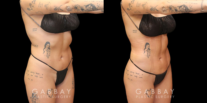 Female patient after precise liposuction techniques removed stubborn fat, smoothing the belly area while also removing fat from the back and sides. Patient’s recovery went smoothly and was excited to maintain her results.