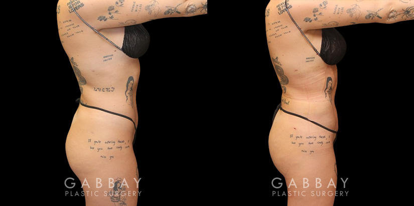 Female patient after precise liposuction techniques removed stubborn fat, smoothing the belly area while also removing fat from the back and sides. Patient’s recovery went smoothly and was excited to maintain her results.