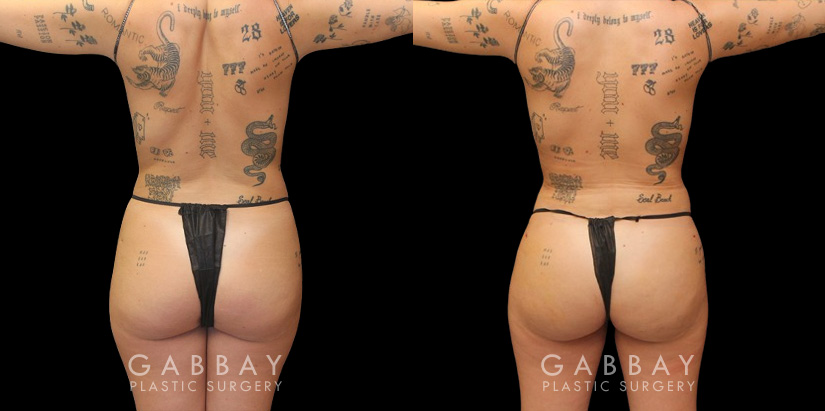 Female patient after precise liposuction techniques removed stubborn fat, smoothing the belly area while also removing fat from the back and sides. Patient’s recovery went smoothly and was excited to maintain her results.