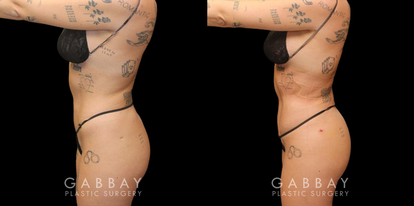 Female patient after precise liposuction techniques removed stubborn fat, smoothing the belly area while also removing fat from the back and sides. Patient’s recovery went smoothly and was excited to maintain her results.