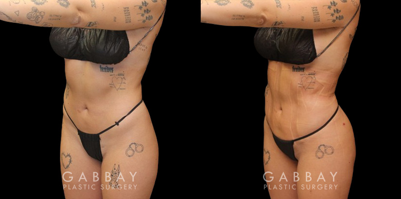 Female patient after precise liposuction techniques removed stubborn fat, smoothing the belly area while also removing fat from the back and sides. Patient’s recovery went smoothly and was excited to maintain her results.