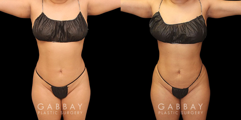 Patient was nearly at her ideal body appearance, but struggled with a few remaining pockets of fat. She underwent liposuction to remove the fat and saw impressive results that bring out her natural body features with a smoother torso in front and back.