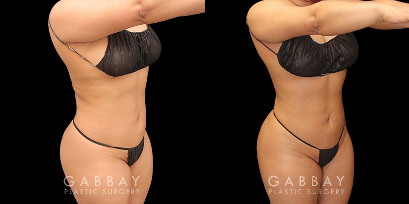 Patient was nearly at her ideal body appearance, but struggled with a few remaining pockets of fat. She underwent liposuction to remove the fat and saw impressive results that bring out her natural body features with a smoother torso in front and back.