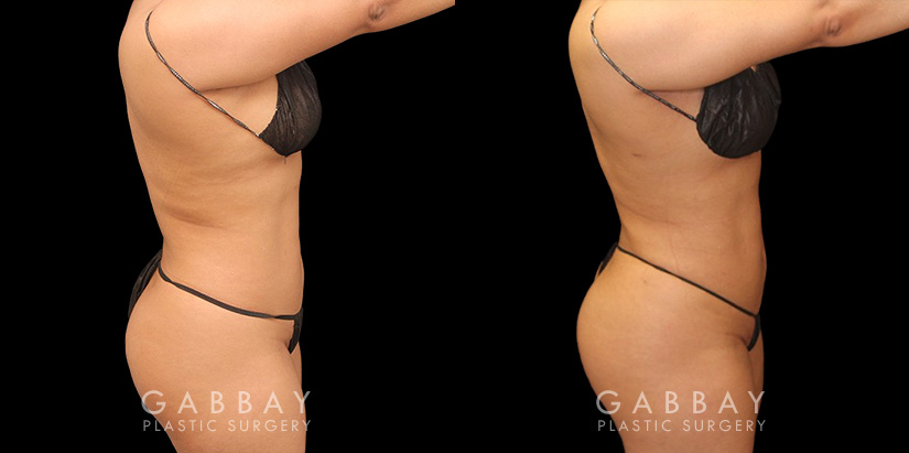 Patient was nearly at her ideal body appearance, but struggled with a few remaining pockets of fat. She underwent liposuction to remove the fat and saw impressive results that bring out her natural body features with a smoother torso in front and back.