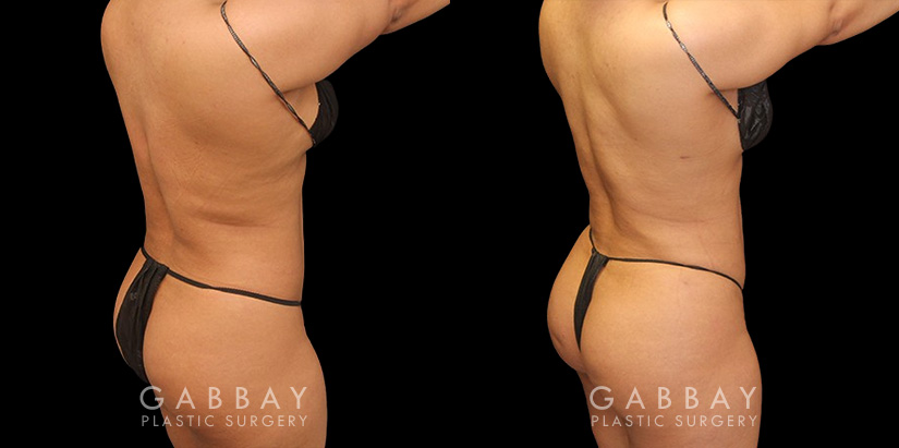 Patient was nearly at her ideal body appearance, but struggled with a few remaining pockets of fat. She underwent liposuction to remove the fat and saw impressive results that bring out her natural body features with a smoother torso in front and back.