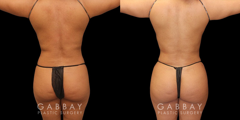 Patient was nearly at her ideal body appearance, but struggled with a few remaining pockets of fat. She underwent liposuction to remove the fat and saw impressive results that bring out her natural body features with a smoother torso in front and back.