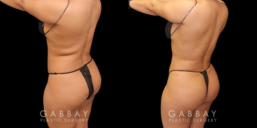 Patient was nearly at her ideal body appearance, but struggled with a few remaining pockets of fat. She underwent liposuction to remove the fat and saw impressive results that bring out her natural body features with a smoother torso in front and back.