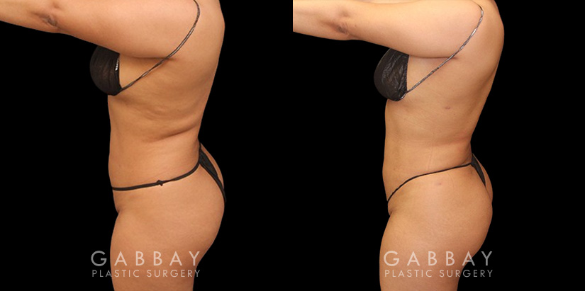 Patient was nearly at her ideal body appearance, but struggled with a few remaining pockets of fat. She underwent liposuction to remove the fat and saw impressive results that bring out her natural body features with a smoother torso in front and back.