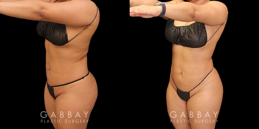 Patient was nearly at her ideal body appearance, but struggled with a few remaining pockets of fat. She underwent liposuction to remove the fat and saw impressive results that bring out her natural body features with a smoother torso in front and back.