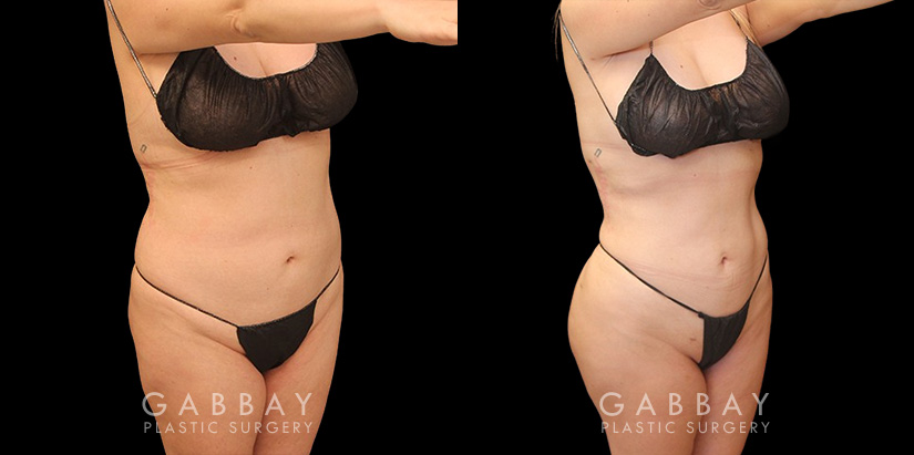 Female patient after liposuction that was combined with fat transfer to the buttocks. This lipo and BBL combination produced a slimmer figure while enhancing the roundness of the butt.