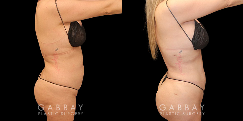 Female patient after liposuction that was combined with fat transfer to the buttocks. This lipo and BBL combination produced a slimmer figure while enhancing the roundness of the butt.