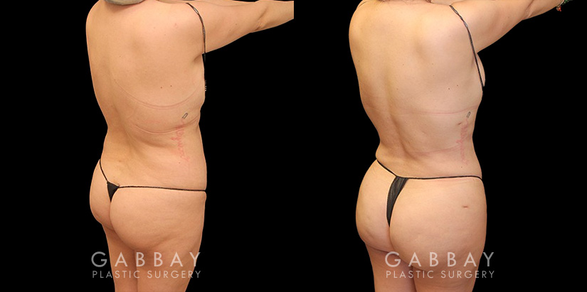 Female patient after liposuction that was combined with fat transfer to the buttocks. This lipo and BBL combination produced a slimmer figure while enhancing the roundness of the butt.