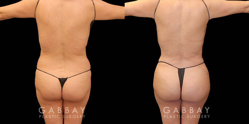 Female patient after liposuction that was combined with fat transfer to the buttocks. This lipo and BBL combination produced a slimmer figure while enhancing the roundness of the butt.