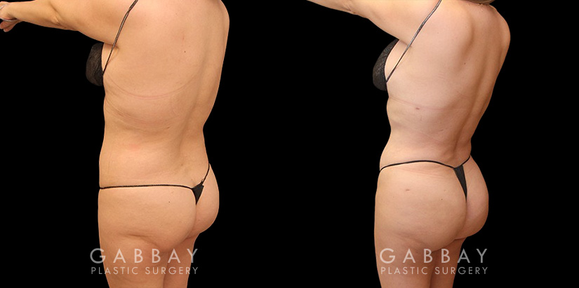 Female patient after liposuction that was combined with fat transfer to the buttocks. This lipo and BBL combination produced a slimmer figure while enhancing the roundness of the butt.