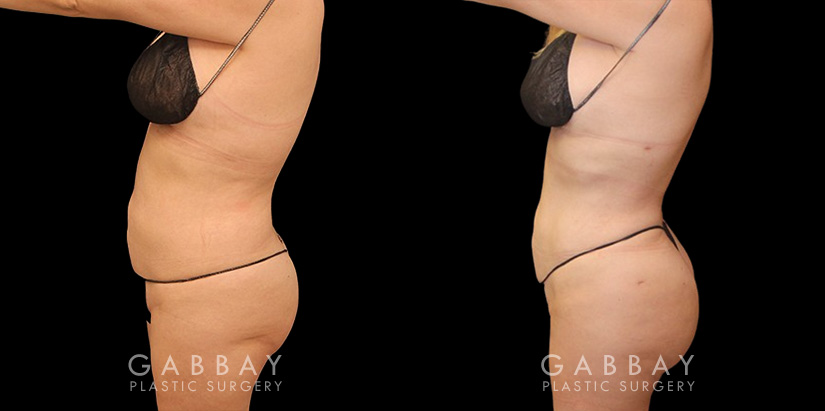 Female patient after liposuction that was combined with fat transfer to the buttocks. This lipo and BBL combination produced a slimmer figure while enhancing the roundness of the butt.