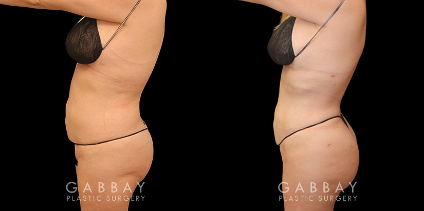 Female patient after liposuction that was combined with fat transfer to the buttocks. This lipo and BBL combination produced a slimmer figure while enhancing the roundness of the butt.