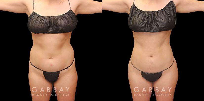 With precise liposuction for the sides, abdomen, and waist, this patient was able to restore her youthful figure and body shape, and achieved virtually no belly fat pockets bulging over the pants line.