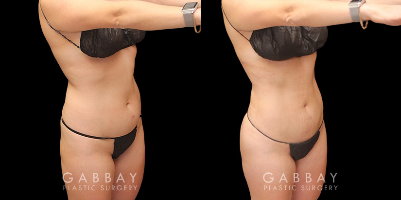 With precise liposuction for the sides, abdomen, and waist, this patient was able to restore her youthful figure and body shape, and achieved virtually no belly fat pockets bulging over the pants line.