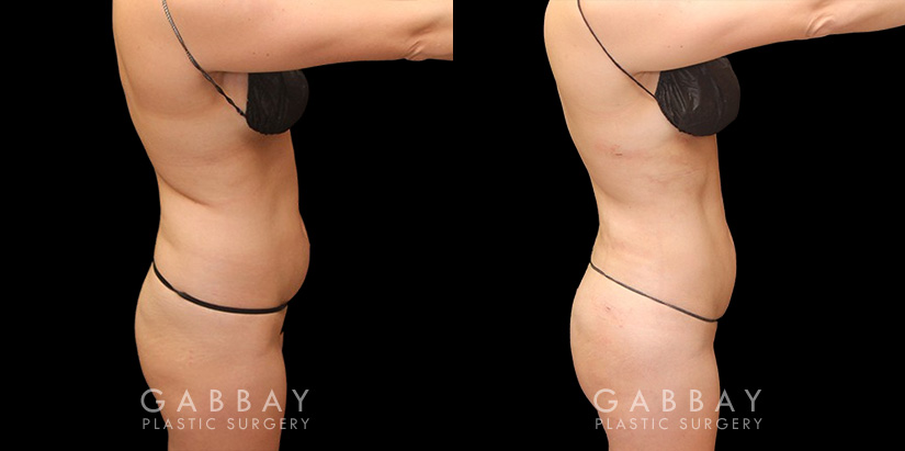 With precise liposuction for the sides, abdomen, and waist, this patient was able to restore her youthful figure and body shape, and achieved virtually no belly fat pockets bulging over the pants line.