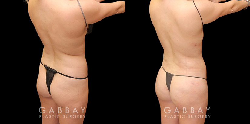 With precise liposuction for the sides, abdomen, and waist, this patient was able to restore her youthful figure and body shape, and achieved virtually no belly fat pockets bulging over the pants line.