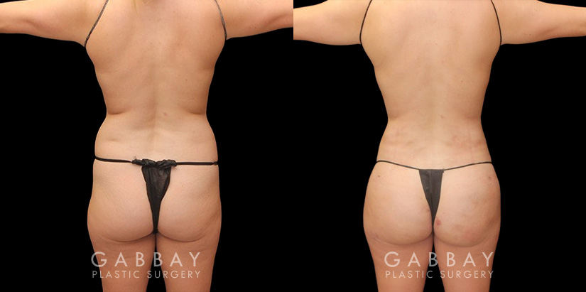 With precise liposuction for the sides, abdomen, and waist, this patient was able to restore her youthful figure and body shape, and achieved virtually no belly fat pockets bulging over the pants line.