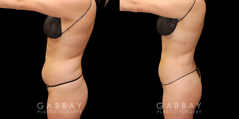 With precise liposuction for the sides, abdomen, and waist, this patient was able to restore her youthful figure and body shape, and achieved virtually no belly fat pockets bulging over the pants line.