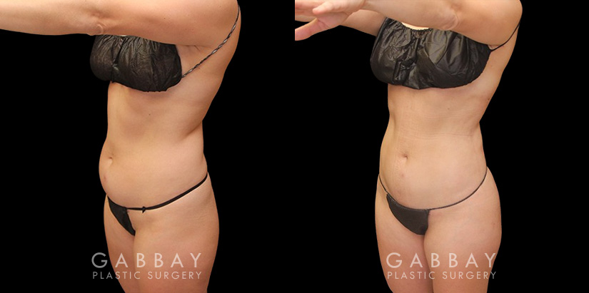 With precise liposuction for the sides, abdomen, and waist, this patient was able to restore her youthful figure and body shape, and achieved virtually no belly fat pockets bulging over the pants line.