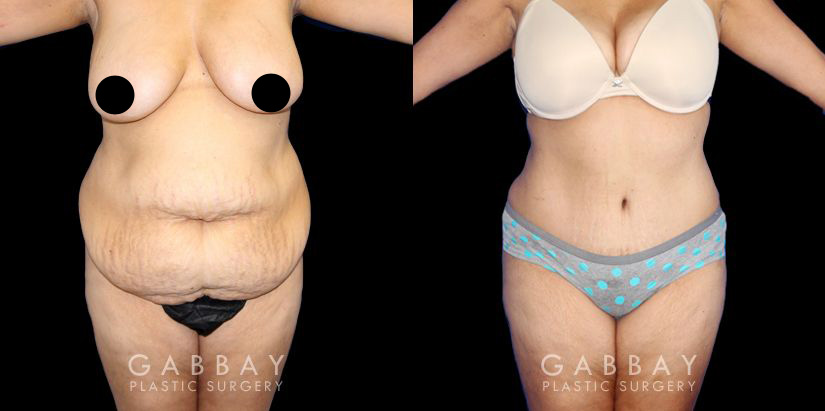 Tummy Tuck Revision - Beverly Hills Physicians