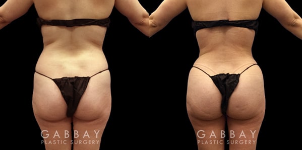 BBL Surgery Before and After Patient 01 Back View Brazilian Butt Lift Before and After Gabbay Plastic Surgery