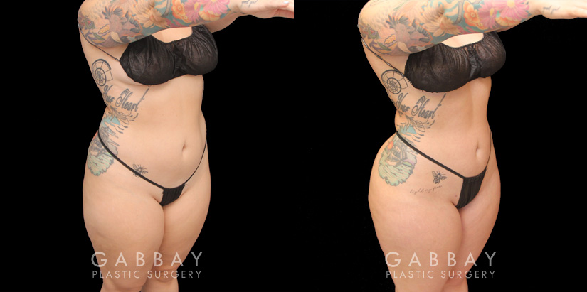BBL before and after of a 360 lipo result with subsequent fat transfer from abs to butt in mid-30s female patient. Results show a dramatic increase in hourglass figure with a lifted butt position, rounded buttocks, and contoured body shape, all with no butt implants used. Natural fat injections settled well for a natural-looking shape and position. Renuvion was used to tighten the patient’s skin and the procedure was done under local anesthesia with the patient awake and comfortable.