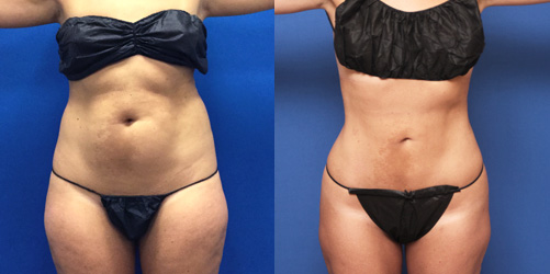 before after image liposuction procedure patient 1