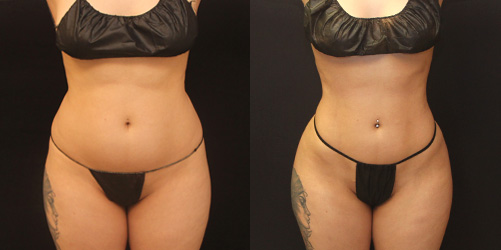 before after image liposuction procedure patient 10