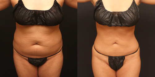 before after image liposuction procedure patient 2