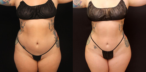 before after image liposuction procedure patient 3