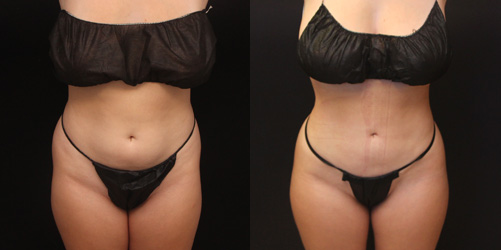 before after image liposuction procedure patient 4