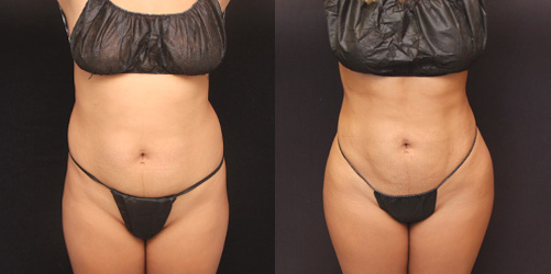 before after image liposuction procedure patient 5