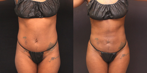 before after image liposuction procedure patient 6