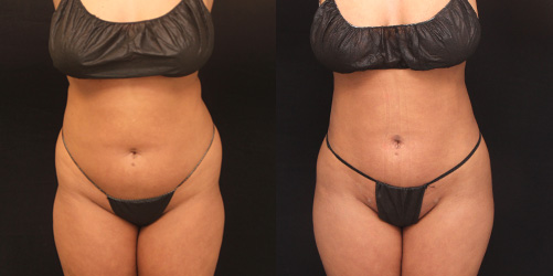 before after image liposuction procedure patient 7